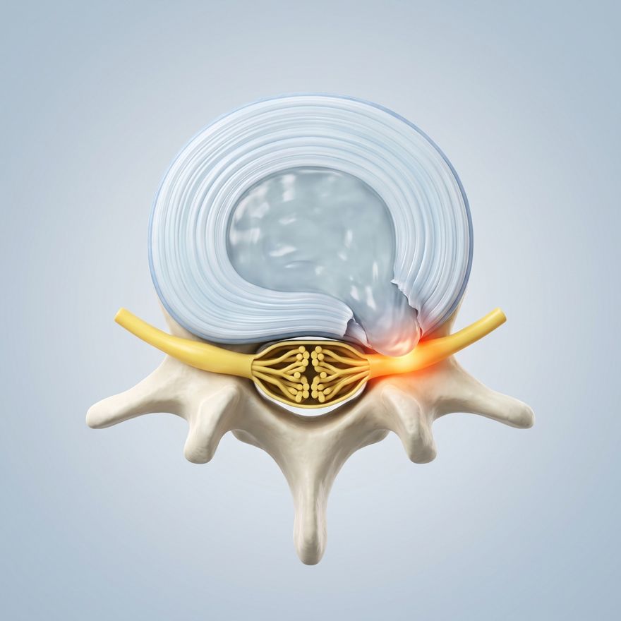 A spinal disc seen from above in cross-section: the layered outer ring of the disc and its soft centre, which pushes out through a tear at the back and to one side and presses on a nerve root leaving the spine; the irritated nerve root glows.