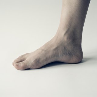 Plantar fasciitis
